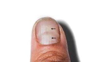 Senile lines or Beau's lines or wavy nails