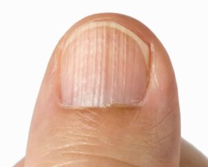 Vertical lines or onychoress