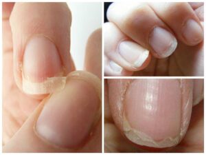 Onychoschizia lamellina